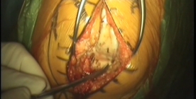 Protesi bimonocompartimentale di ginocchio femoro-tibiale mediale e femoro-rotulea